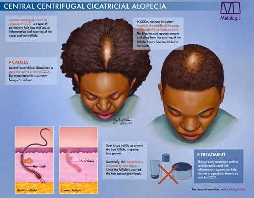 Example of Central Centrifugal Cicatricial Visual Aid