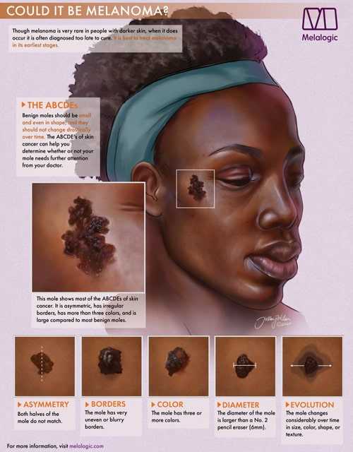 Example of Melanoma Visual Aid