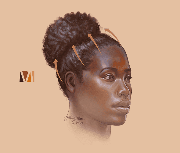 What Is Traction Alopecia Melalogic what-is-traction-alopecia-melalogic
