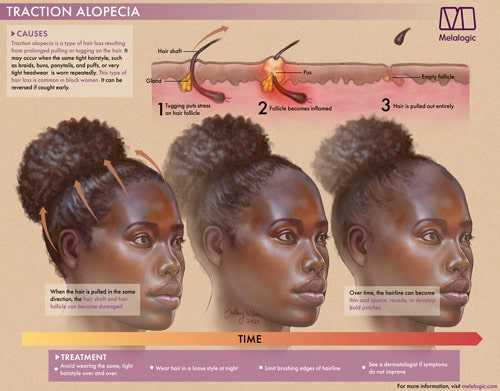 Example of Traction Alopecia Visual Aid